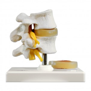 MODELLO ANATOMICO DI Ernia Disco Lombare 3d Delle Vertebre Lombari MODELLO ANATOMICO DI Ernia Disco Lombare 3d Delle Vertebre Lombari
